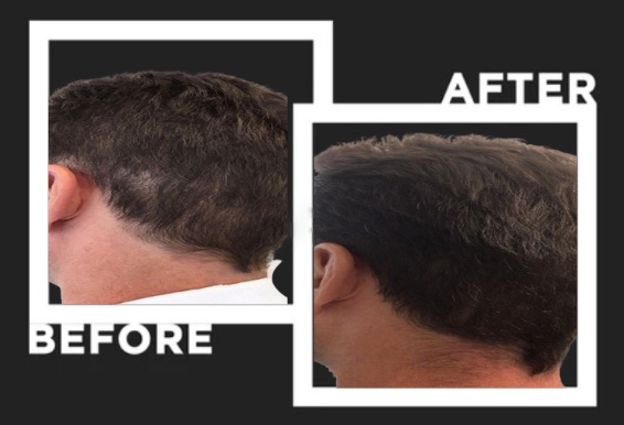 scalpliners scalp micropigmentation scar treatment image