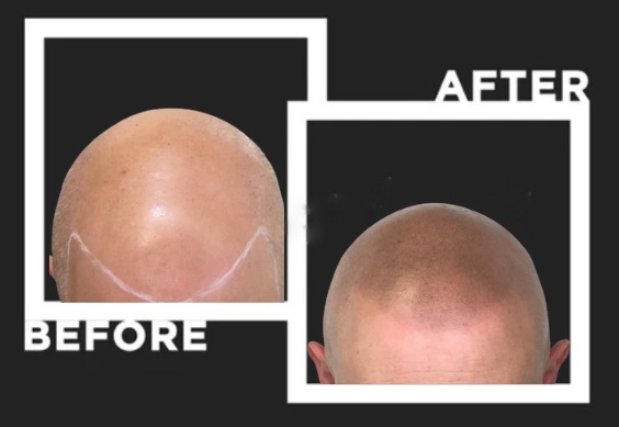 scalpliners scalp micropigmentation hairline image