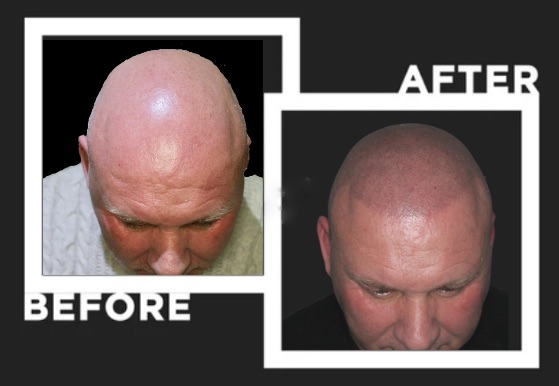 scalpliners scalp micropigmentation bald man smp image