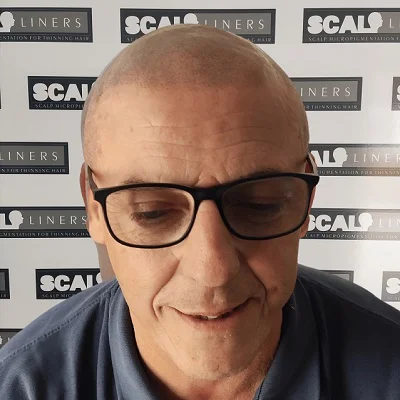 Wayne after scalp micropigmentation hairline restoration at ScalpLiners Kent