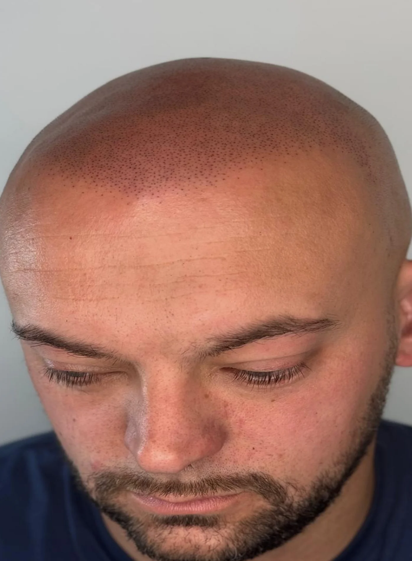 Final scalp micropigmentation blend result in Kent