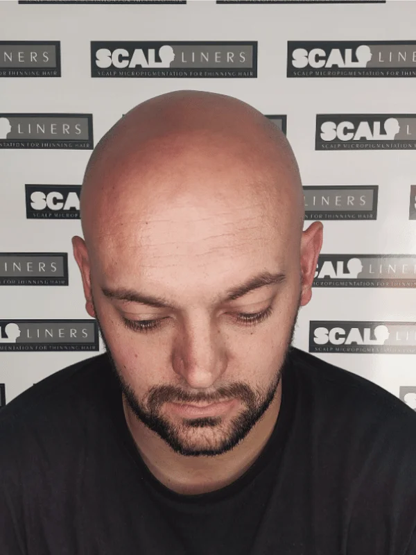 Gary before SMP treatment — hair loss Norwood stage 4 Kent