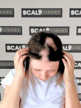 Alopecia scalp micropigmentation treatment Kent — alopecia areata SMP result at ScalpLiners Whitstable