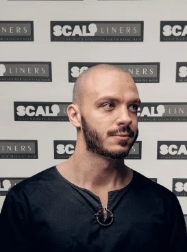 Tom scalp micropigmentation result ScalpLiners Kent