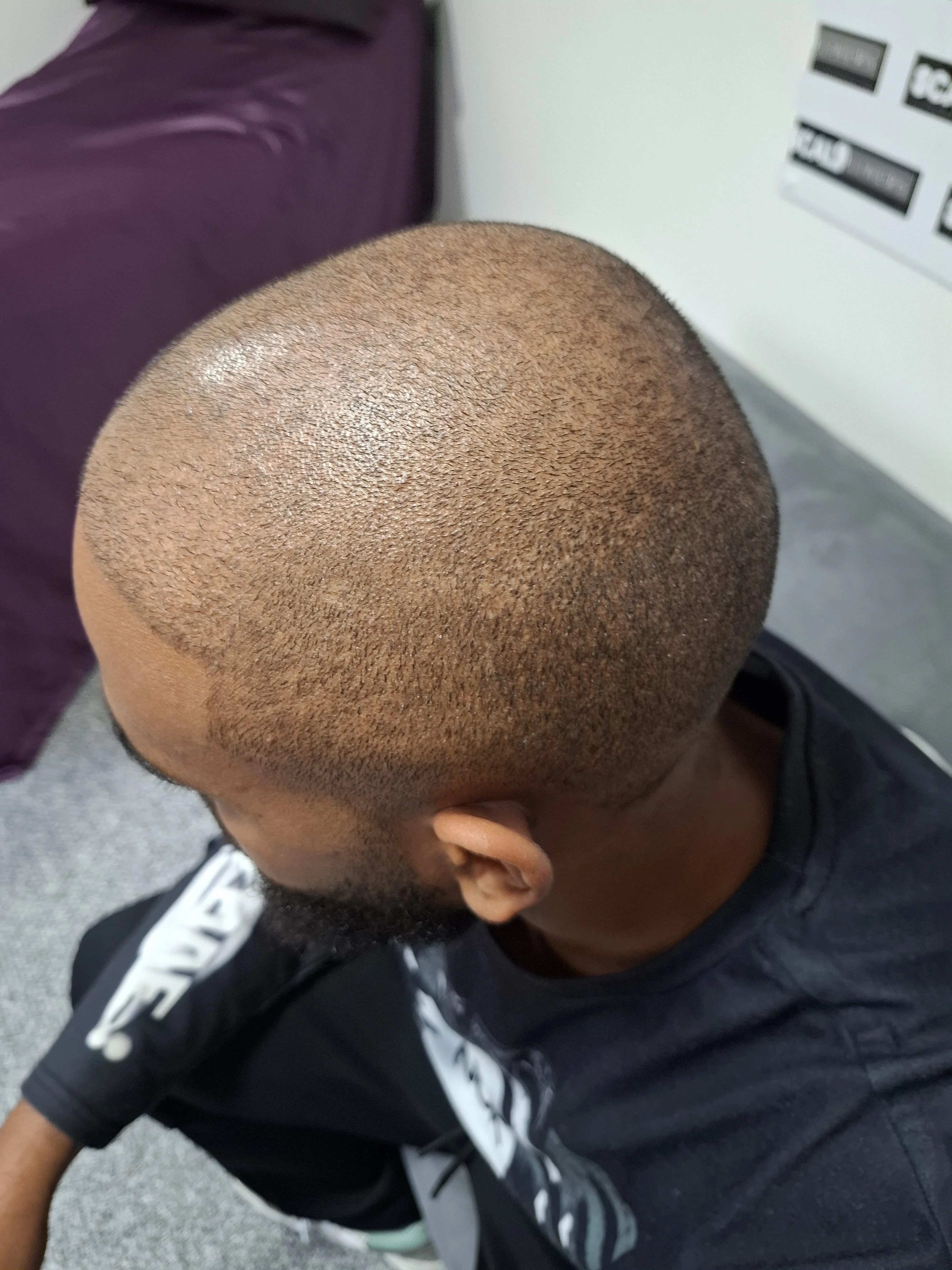 Allie before scalp micropigmentation treatment Kent