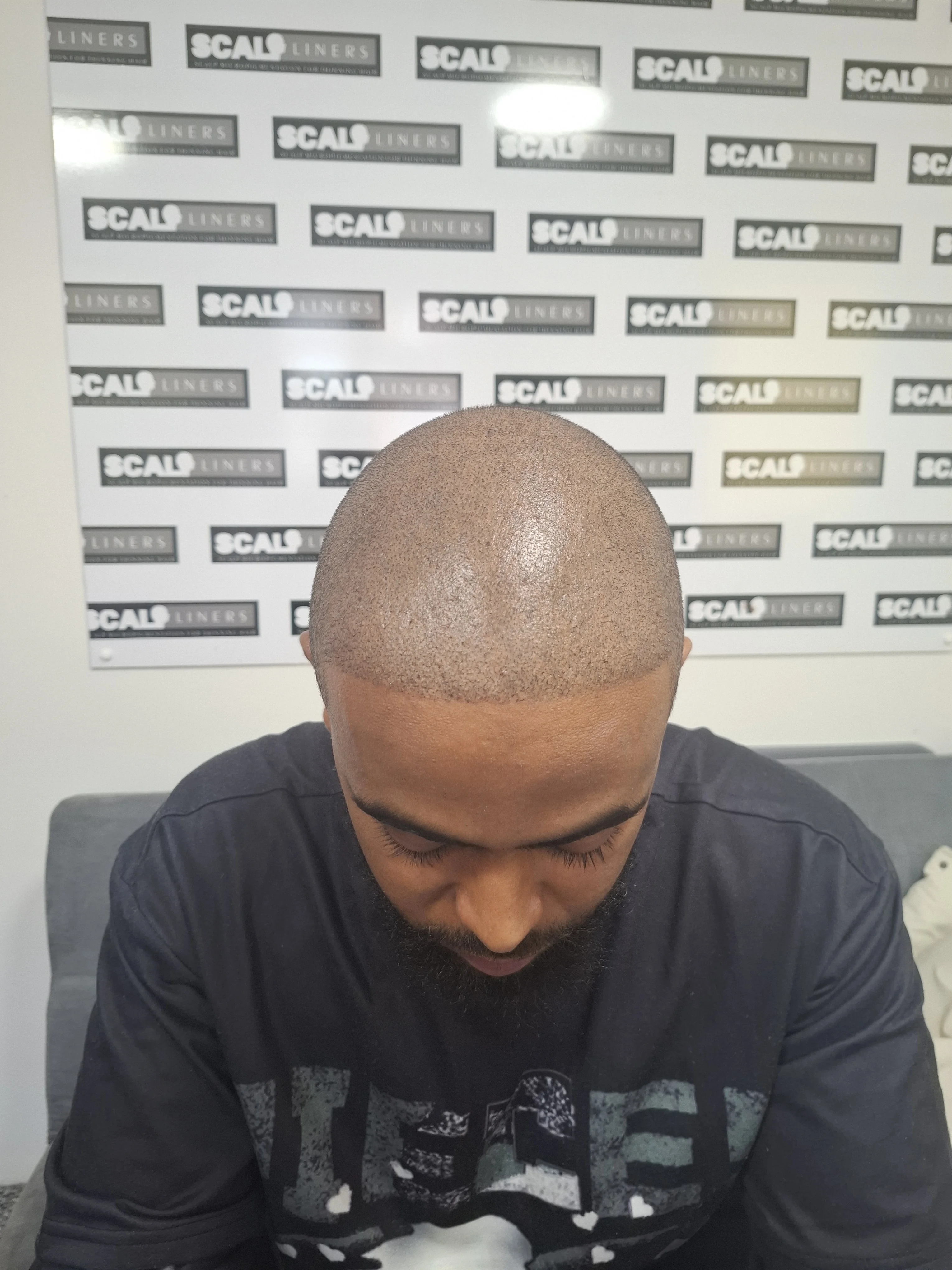 Allie women's SMP density treatment ScalpLiners Kent — session 3