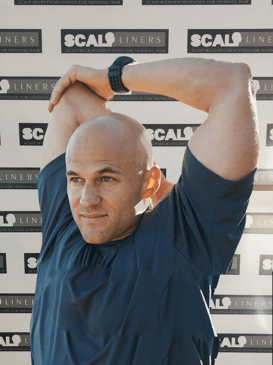 Billy before full head scalp micropigmentation treatment ScalpLiners Kent