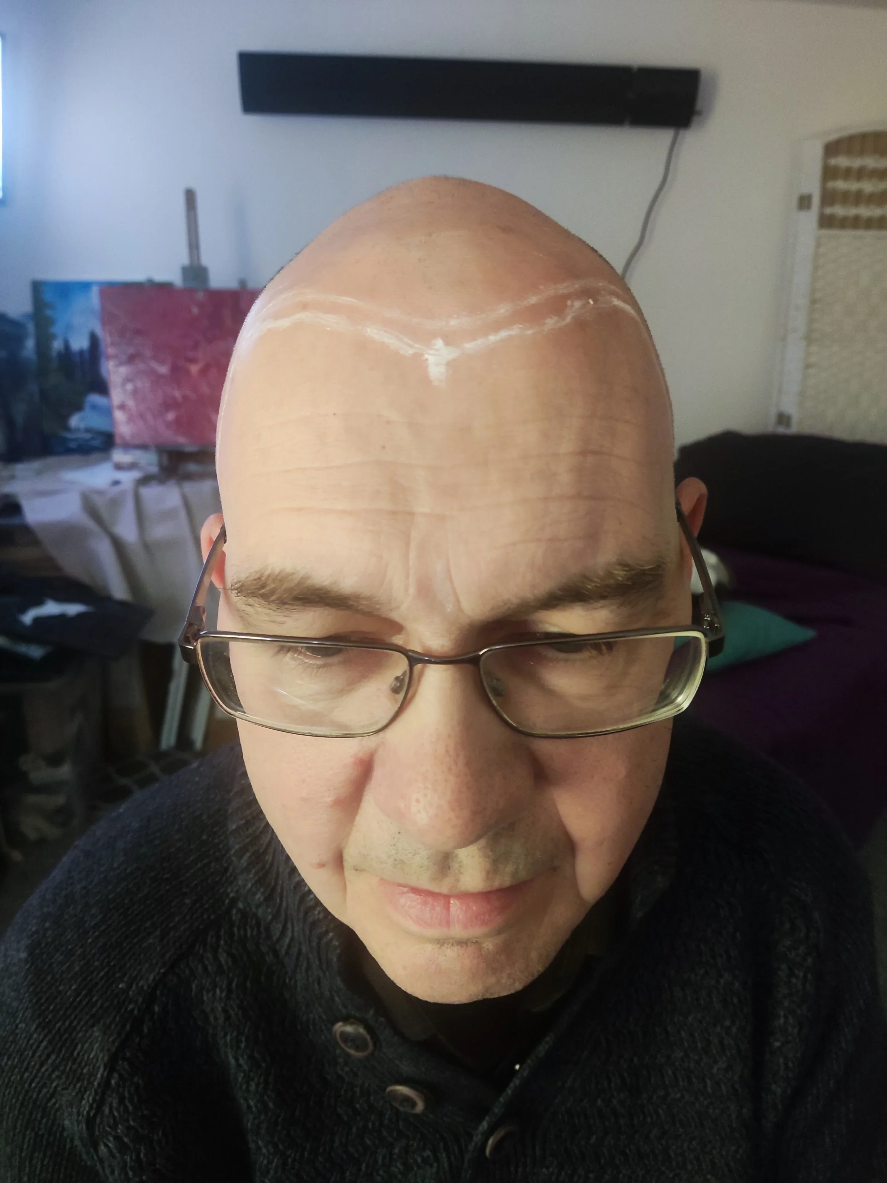 Chris before scalp micropigmentation treatment Maidstone Kent