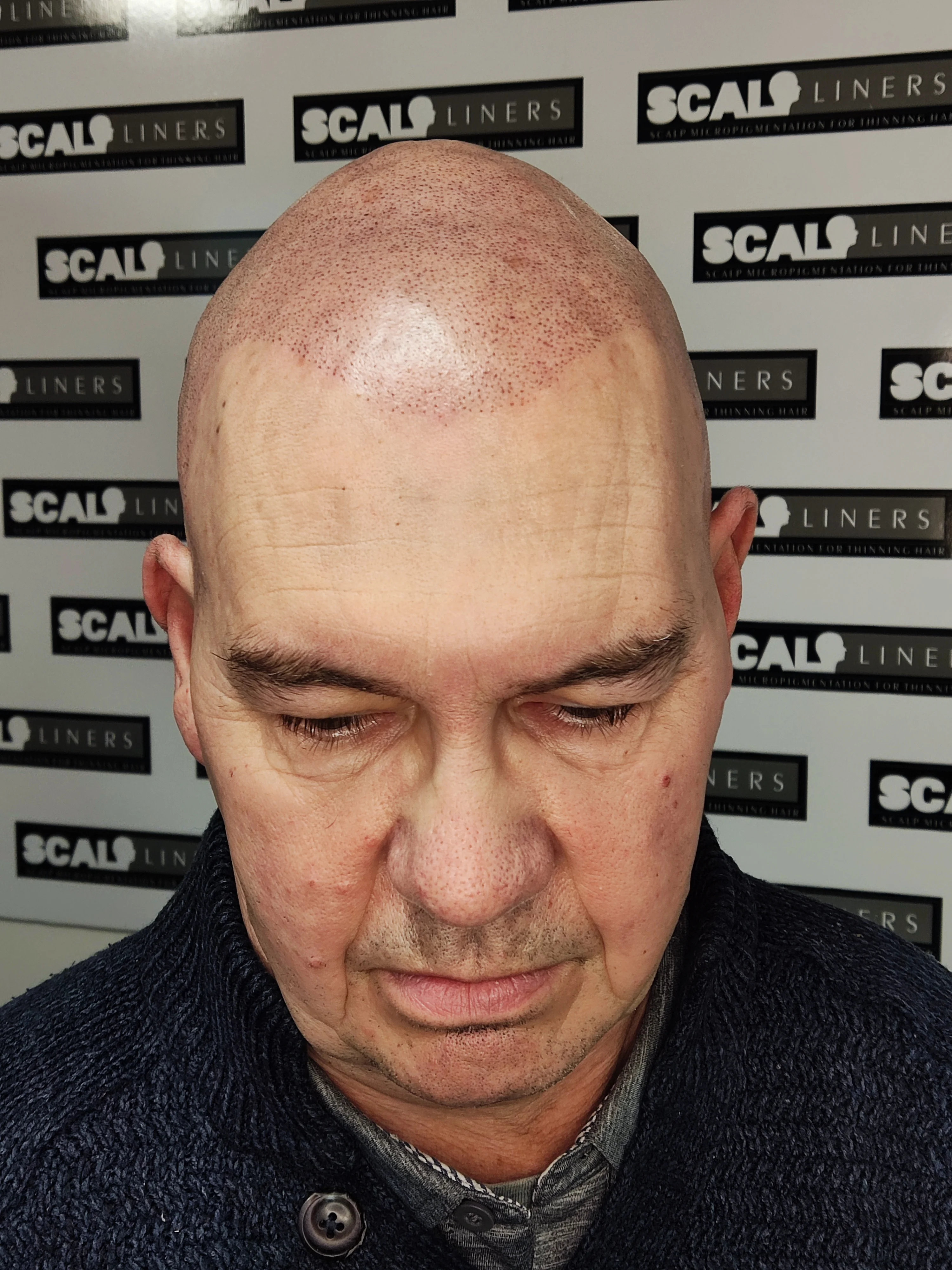 Scalp micropigmentation result for Chris based in Maidstone Kent