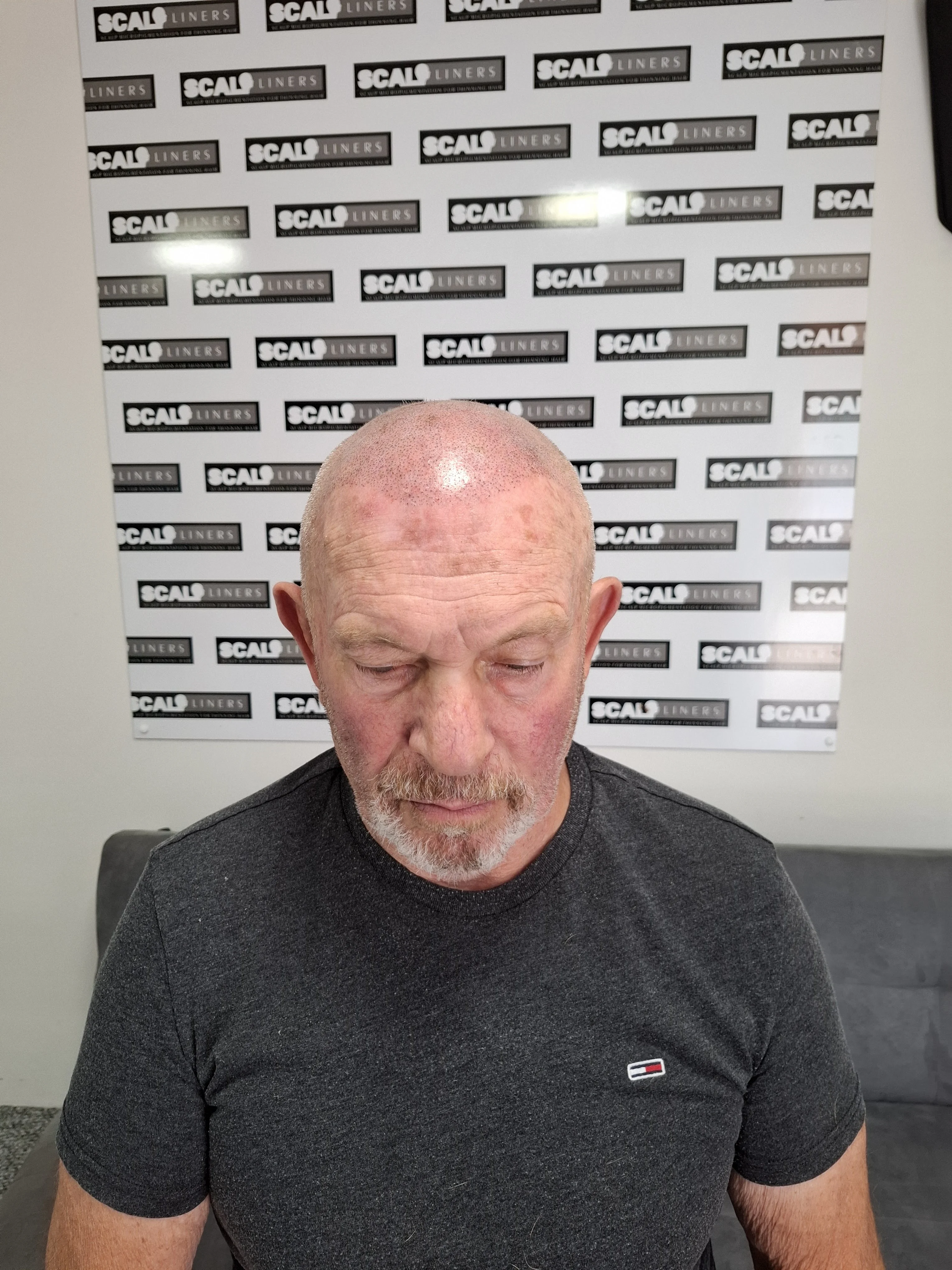 Scalp micropigmentation result for Craig based in Dover Kent