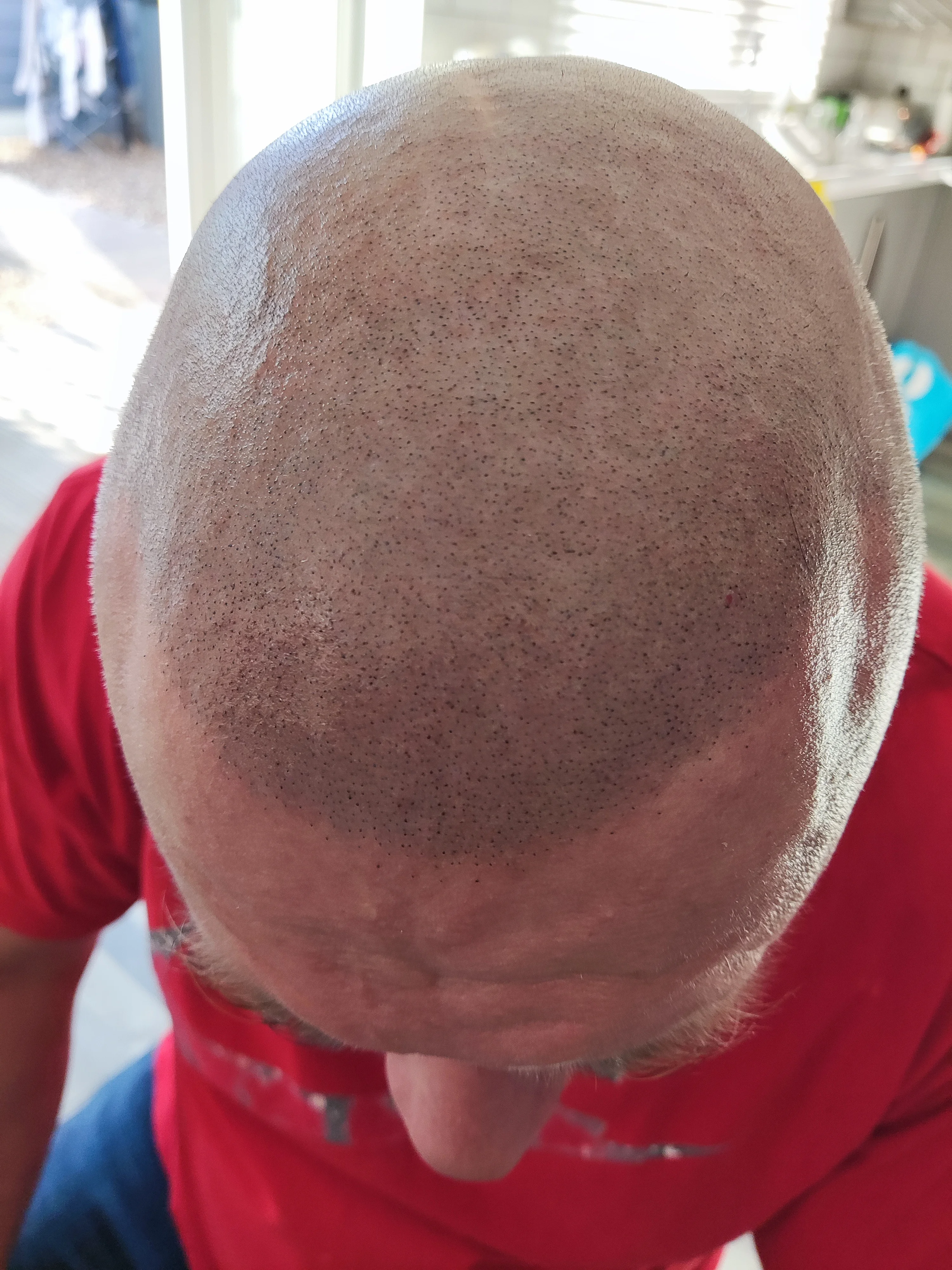 Mark Terrell's first scalp micropigmentation treatment — SMP artist who has had the treatment himself ScalpLiners Kent
