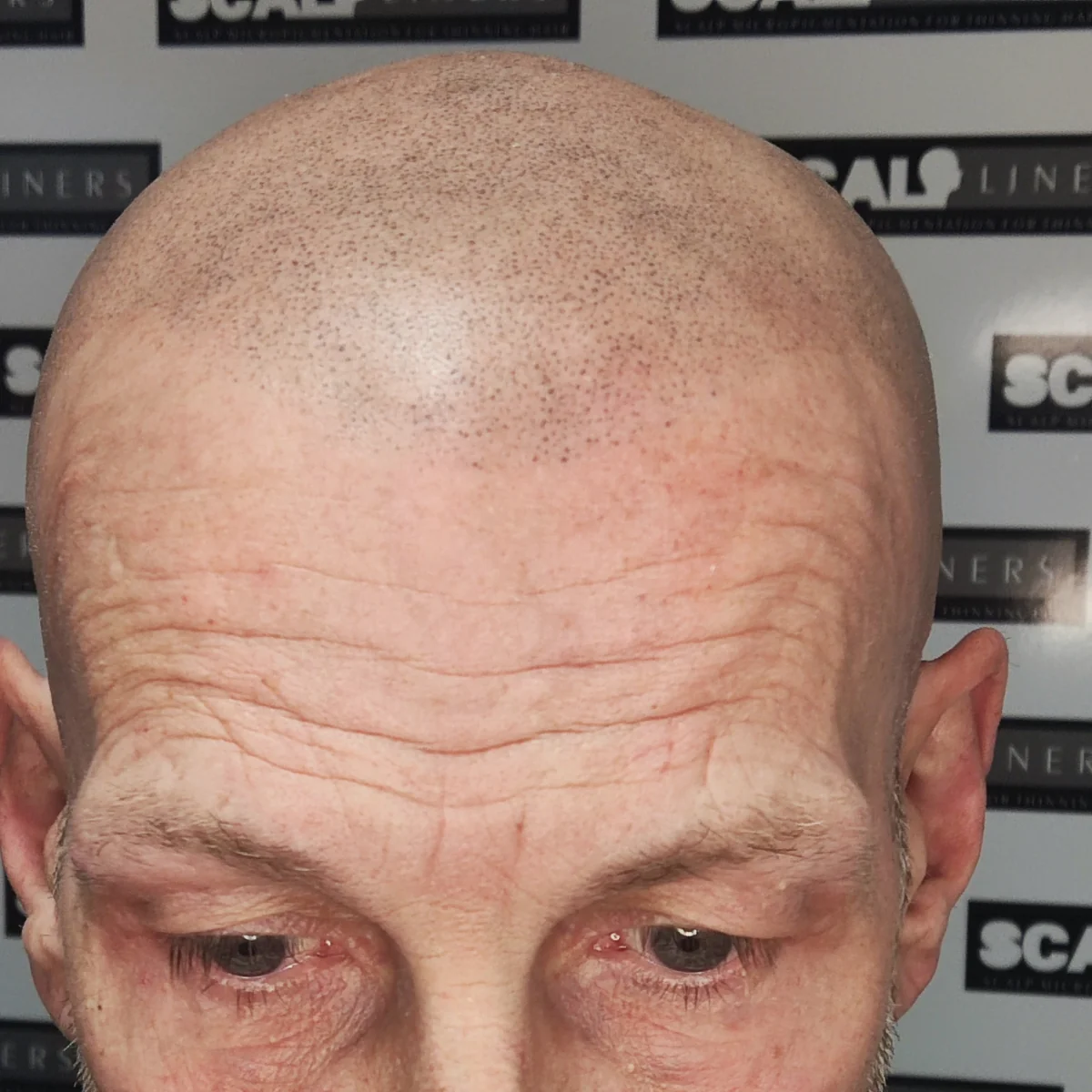 Ian full head scalp micropigmentation result Kent — final result