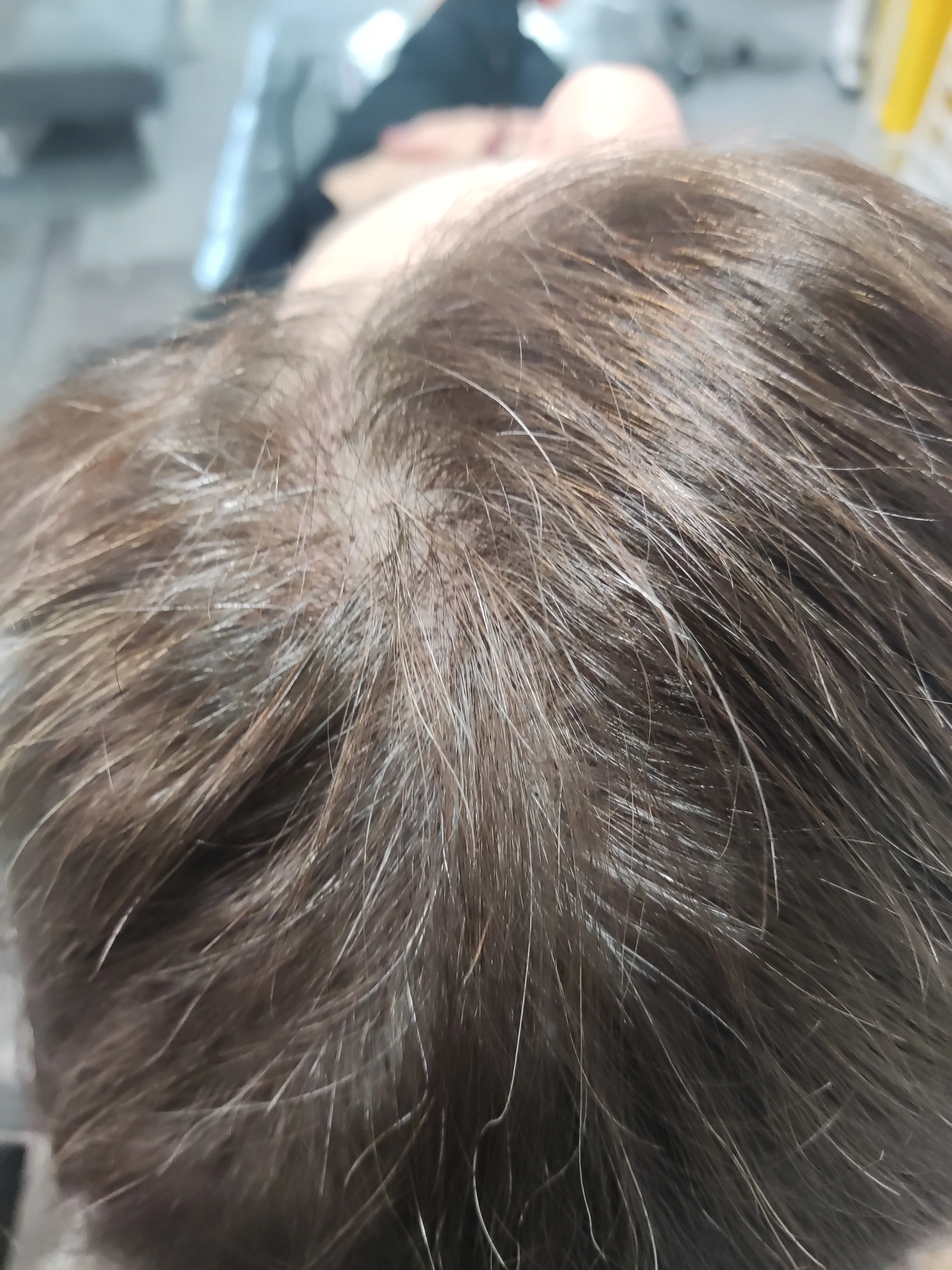 Joanne alopecia SMP result — ScalpLiners Kent