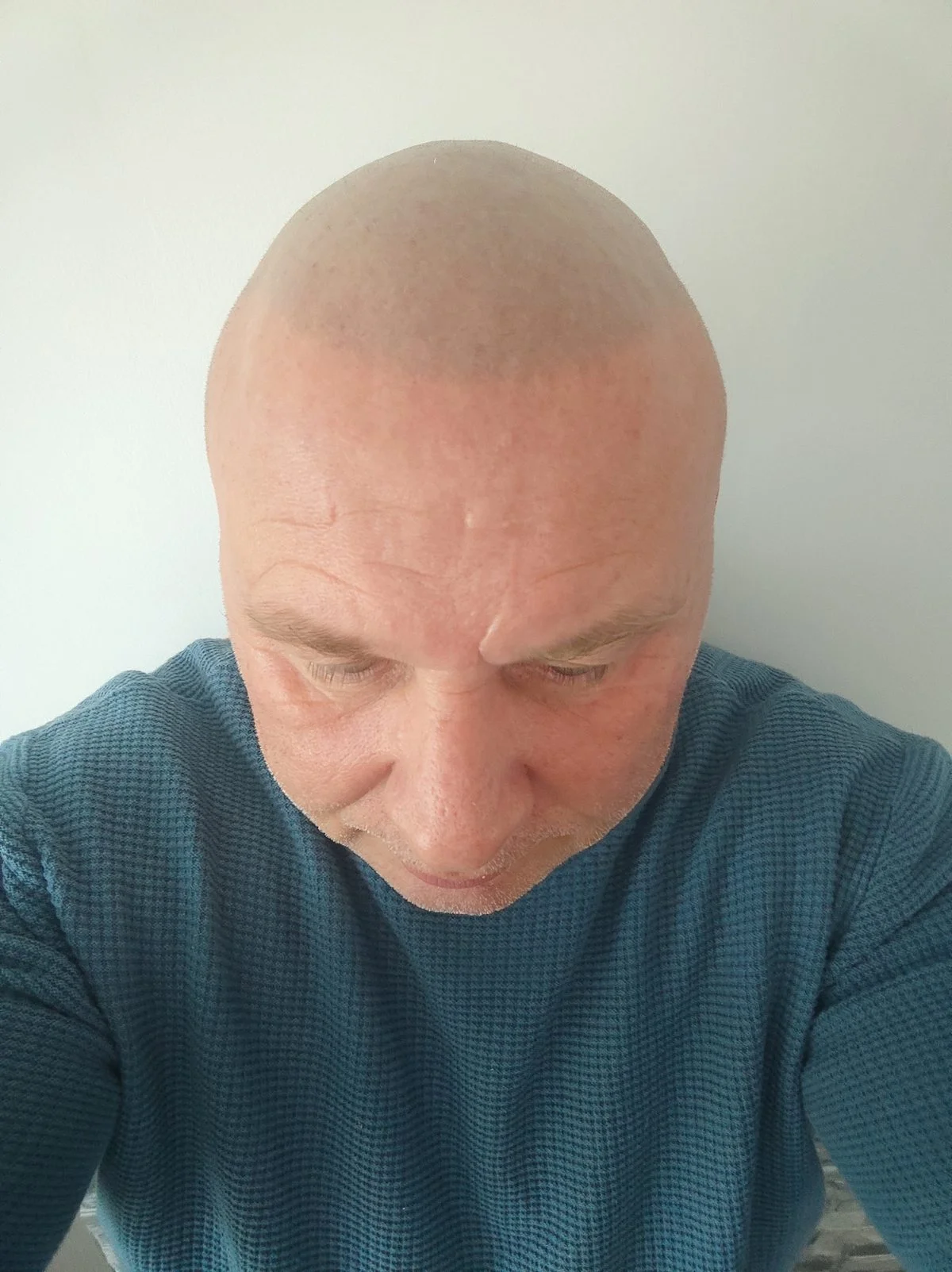 Mark Terrell ScalpLiners owner scalp micropigmentation Whitstable — session 2