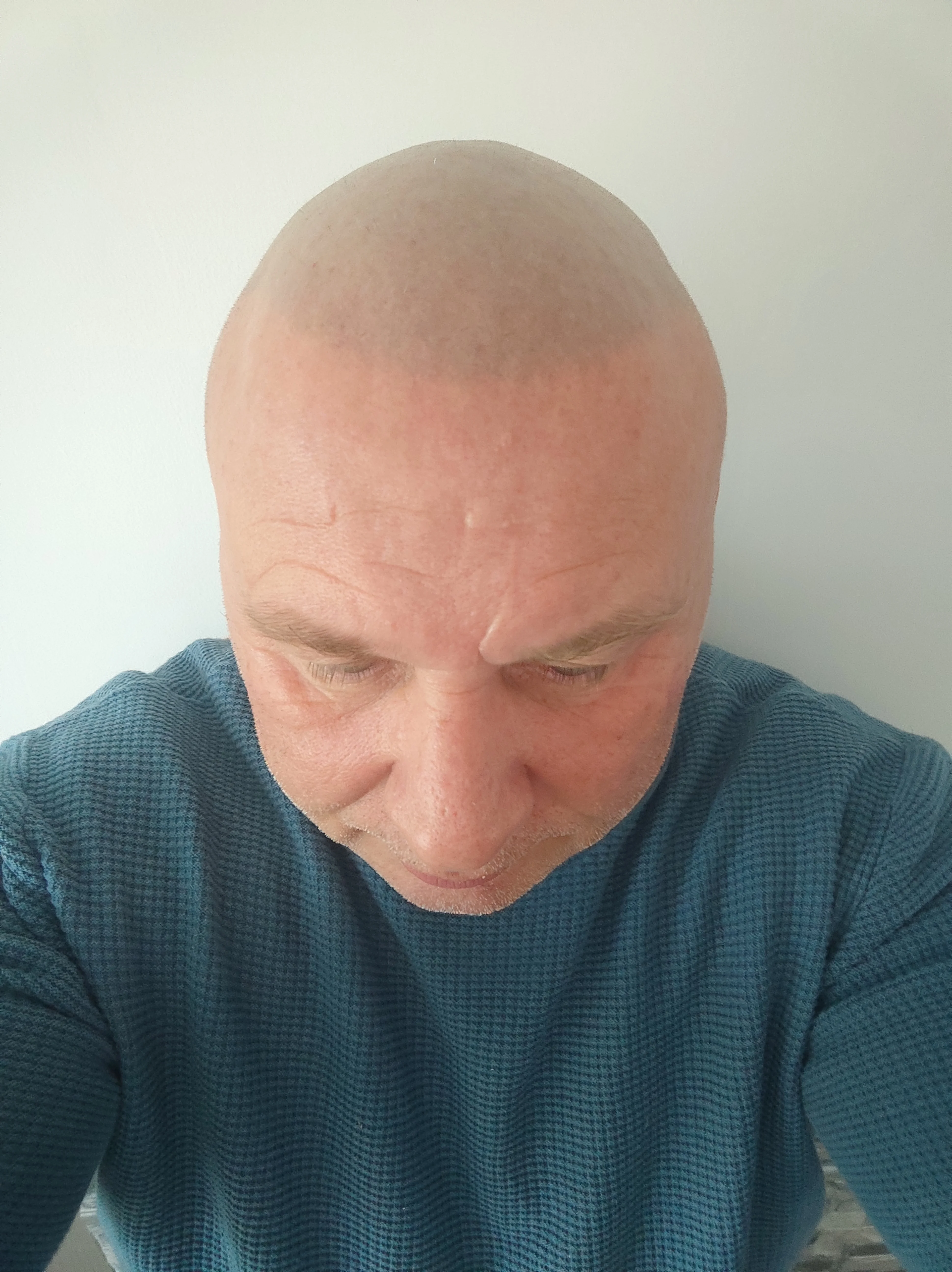 Mark Terrell performing scalp micropigmentation treatment at ScalpLiners clinic Whitstable Kent