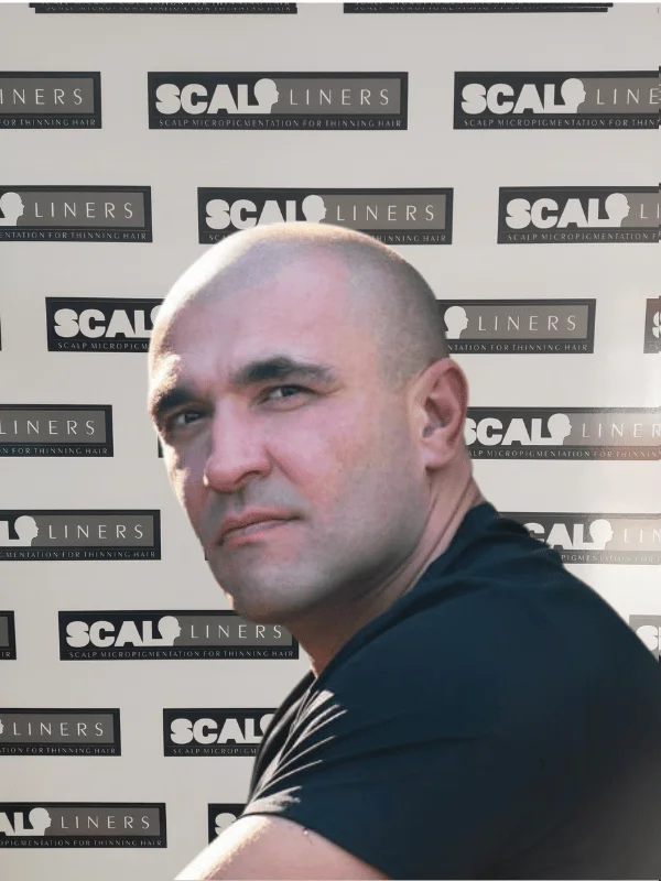 Sammy before scalp micropigmentation treatment at ScalpLiners Whitstable Kent