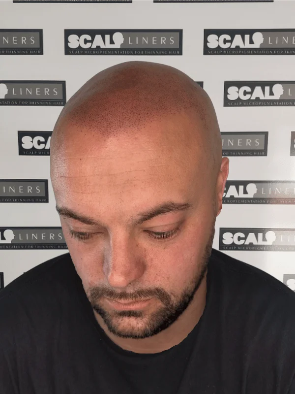 Gary after scalp micropigmentation — full head SMP result ScalpLiners Kent