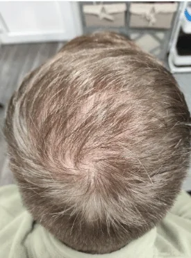 Jim before scalp micropigmentation treatment Broadstairs Kent