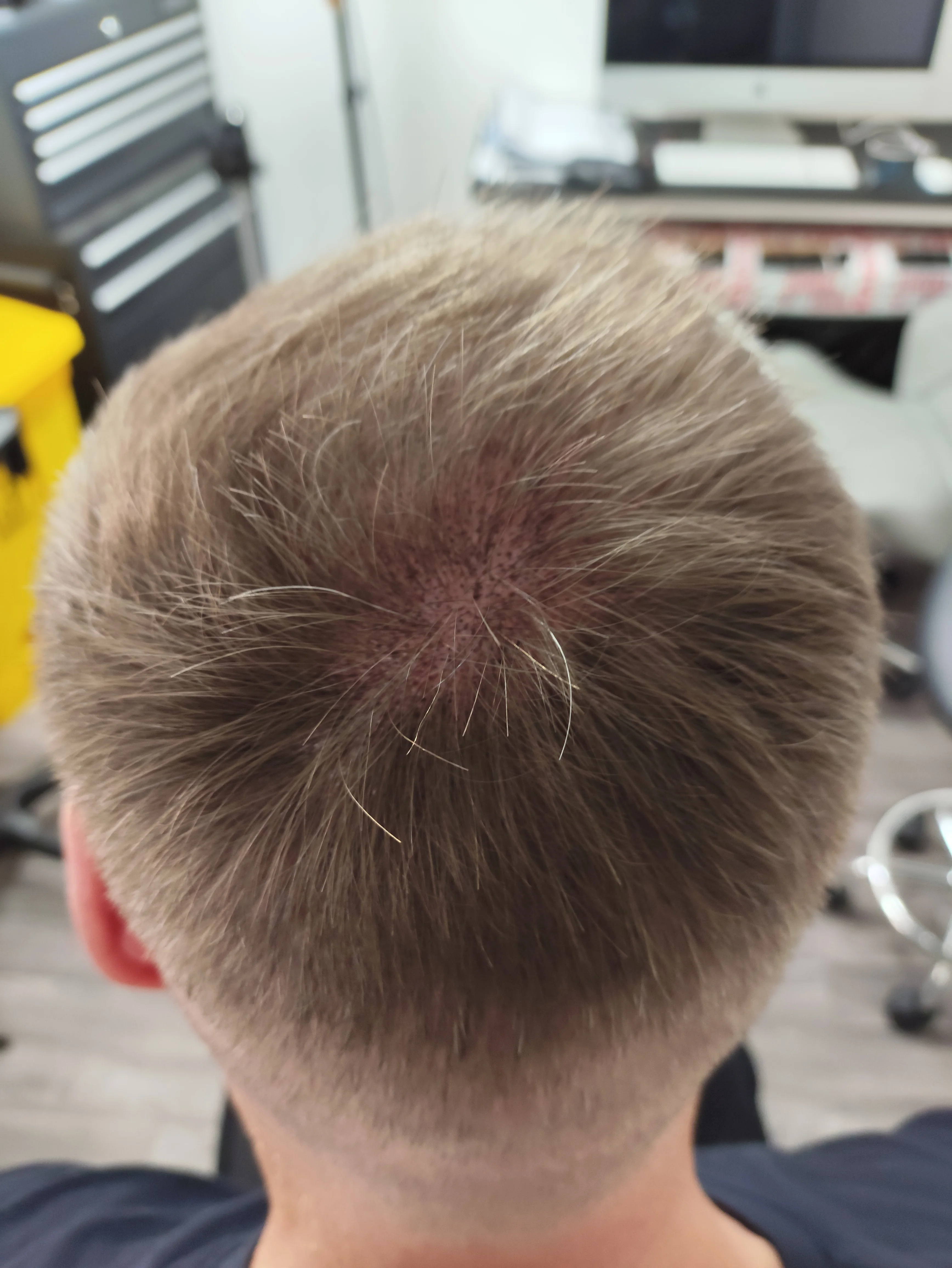 Tony scalp micropigmentation finished result Kent — session 2