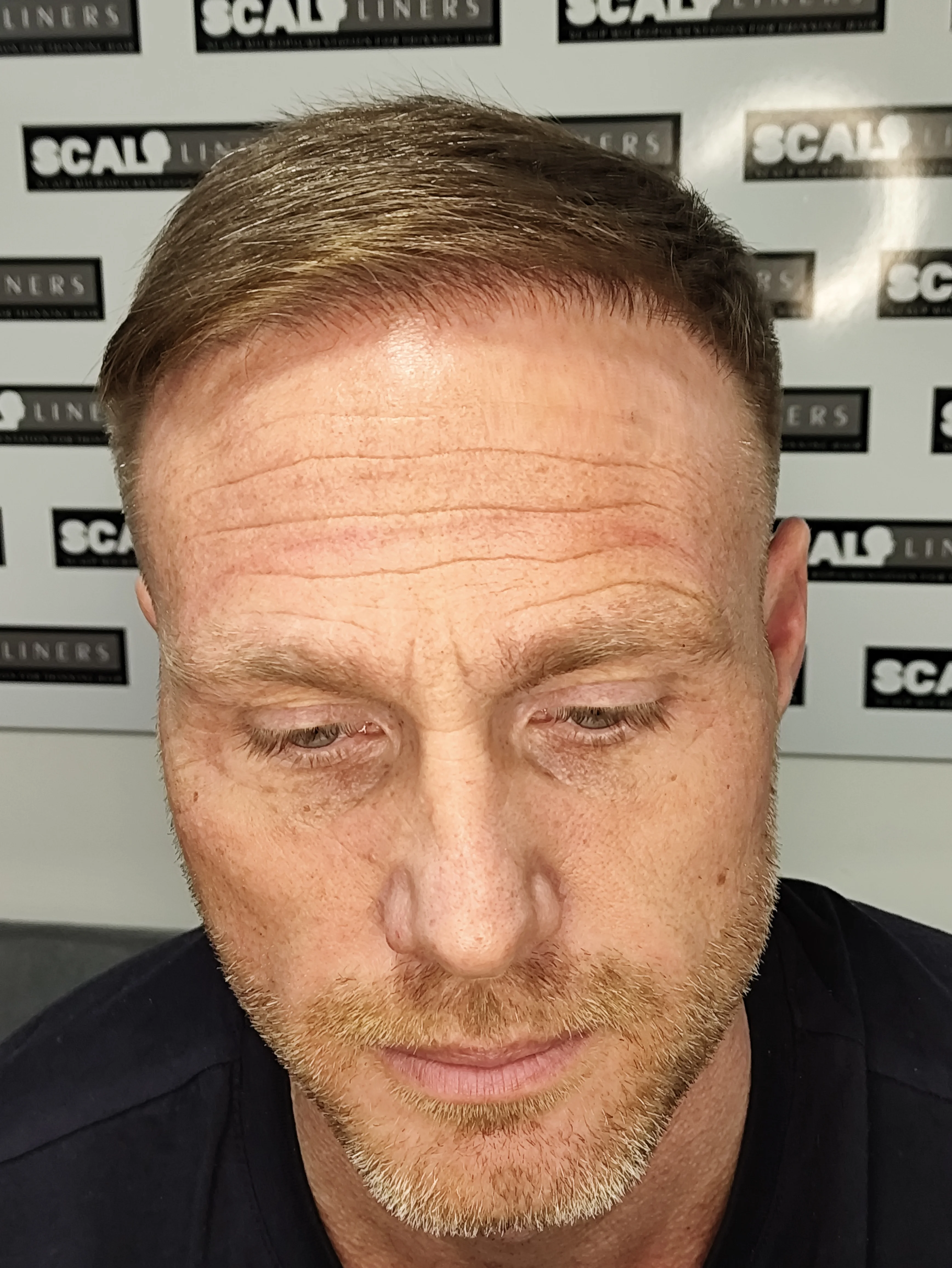 Scalp micropigmentation result for Jim from Broadstairs Kent