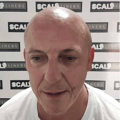 Henry before scalp micropigmentation treatment Sussex