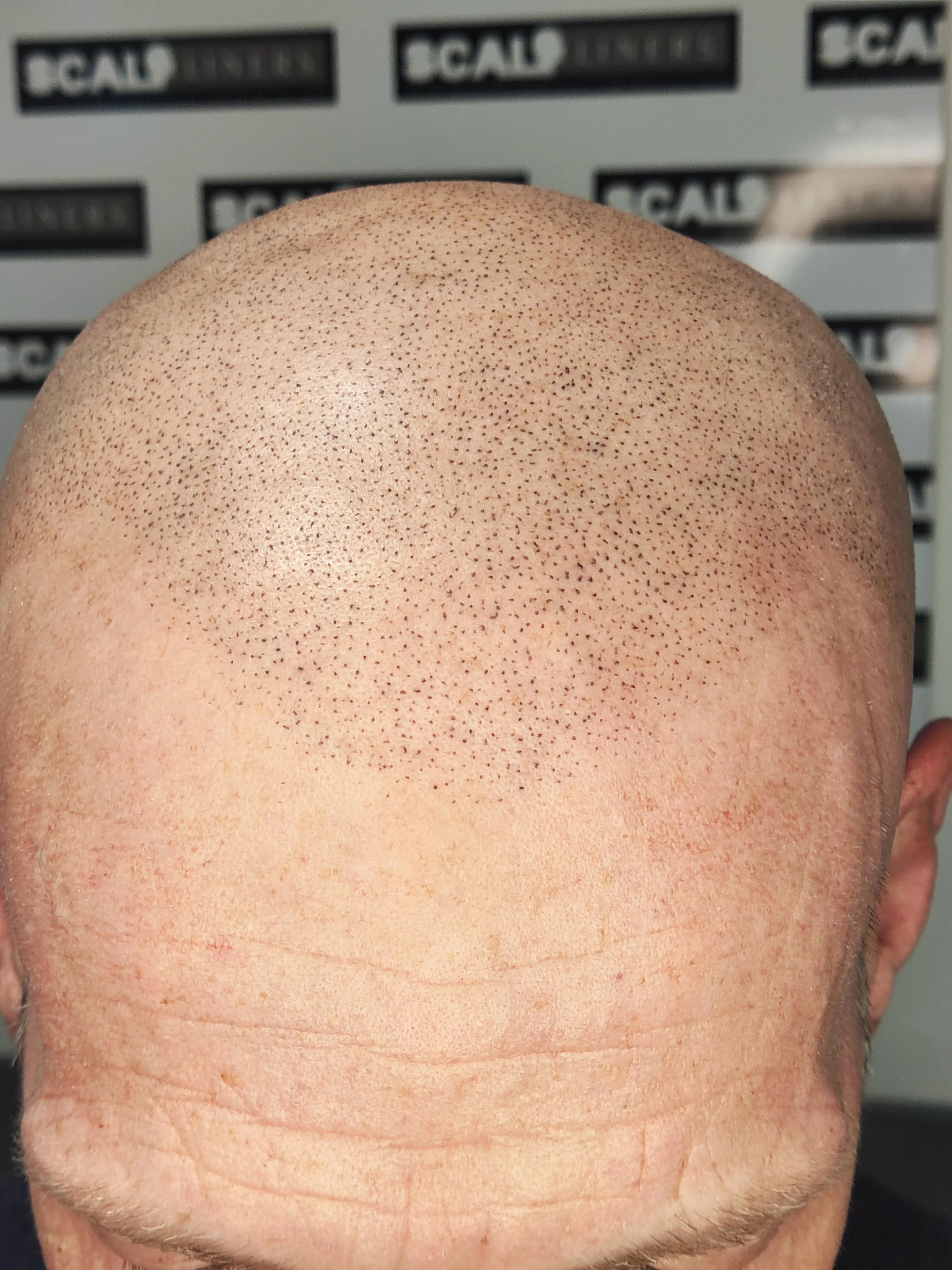 Wayne hairline SMP progress — ScalpLiners Kent