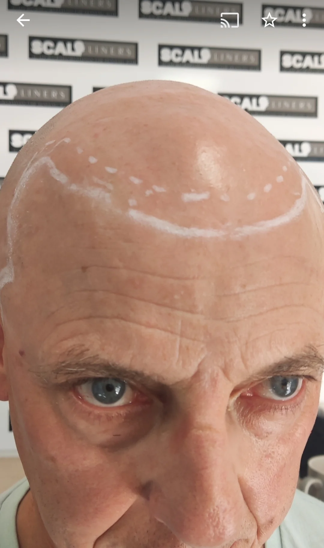 Receding hairline SMP result — Kent client Wayne at ScalpLiners