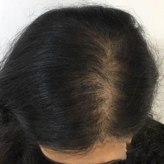 Wendy women's scalp micropigmentation result Whitstable Kent — session 2