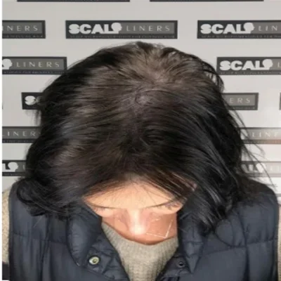 Wendy women's scalp micropigmentation result Whitstable Kent — final result
