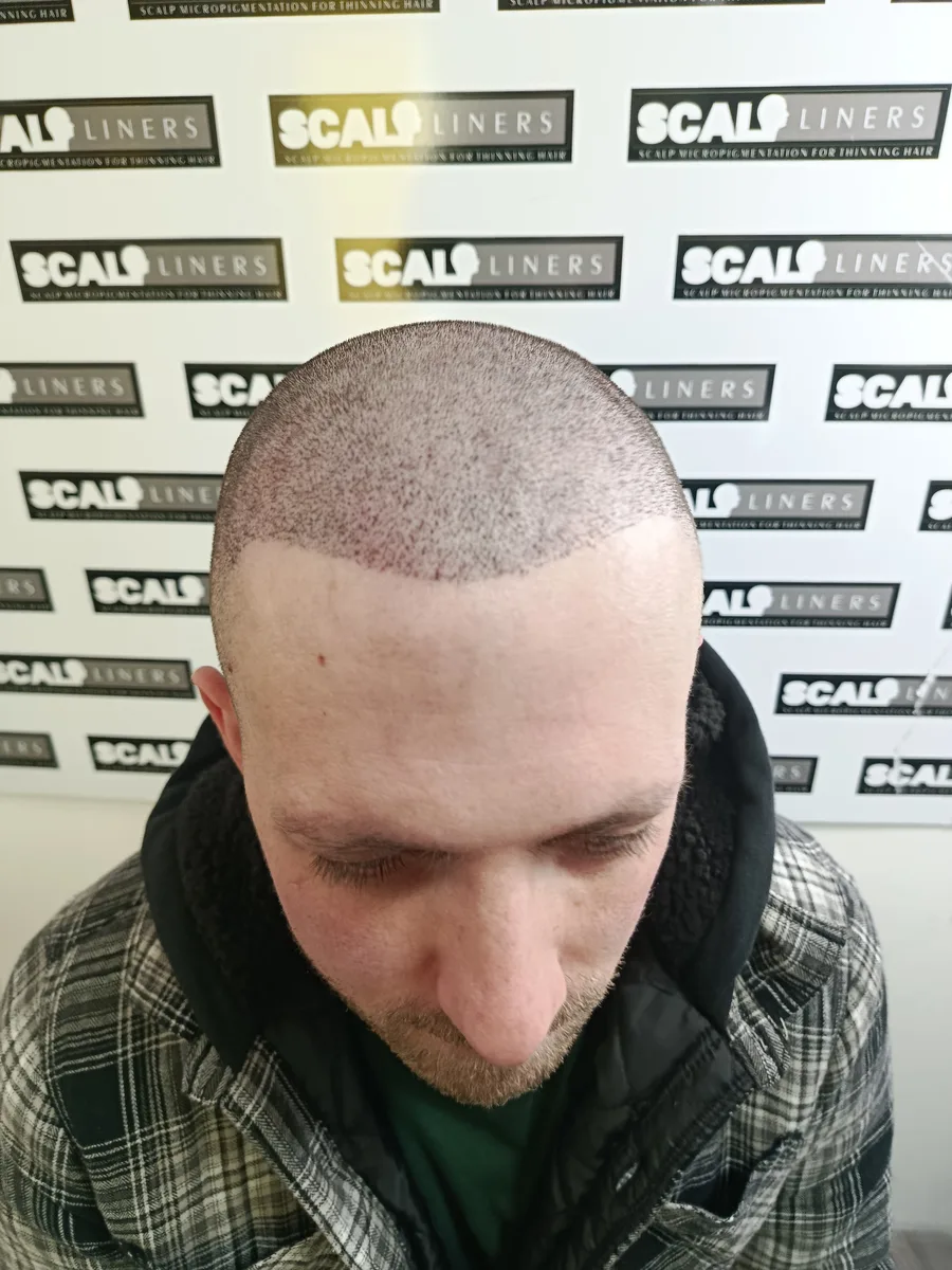Jake full head scalp micropigmentation result in Kent