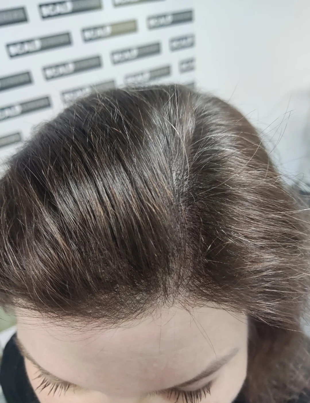 Women's scalp micropigmentation density result in Kent