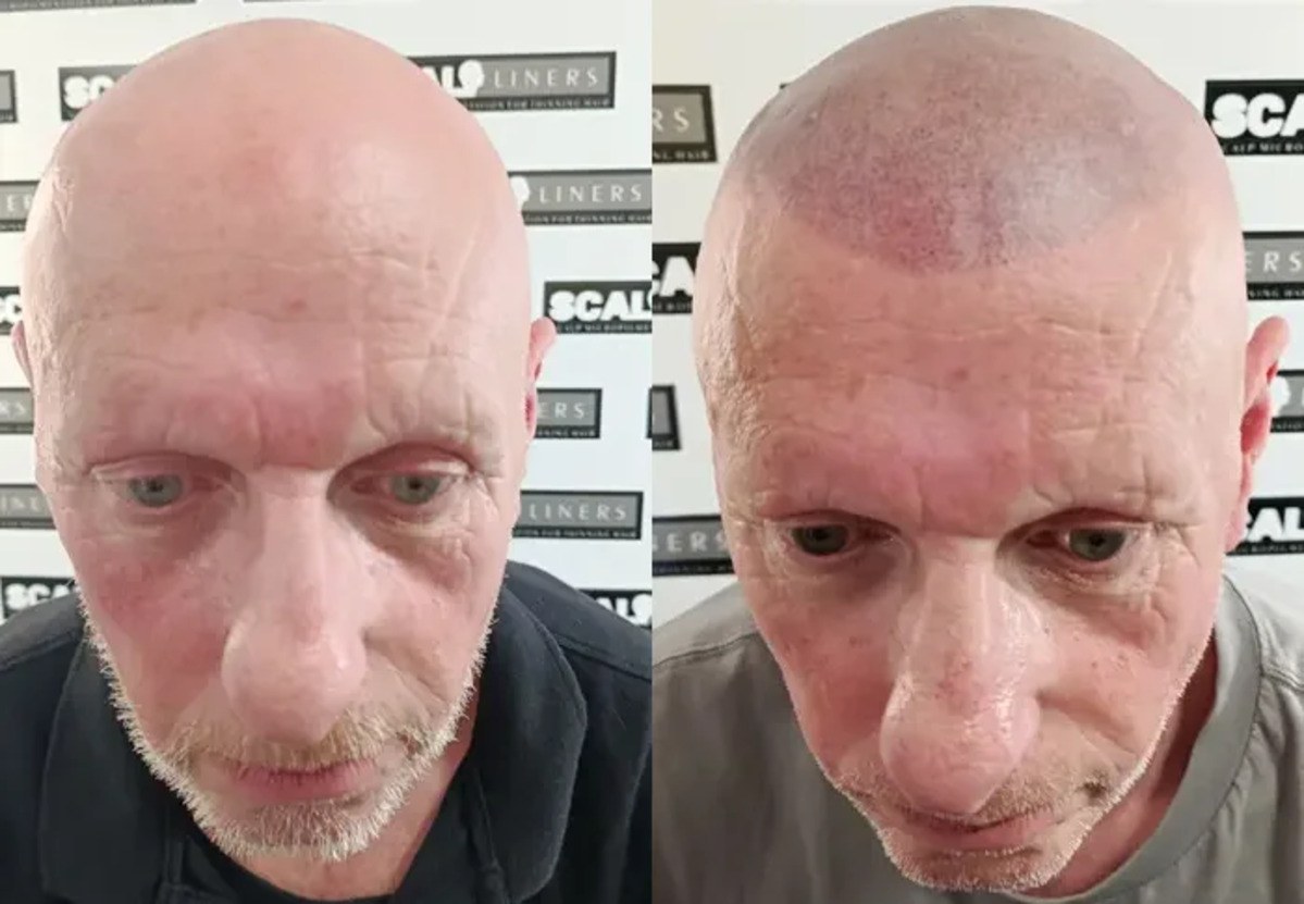 How long does SMP take to heal? - ScalpLiners Kent Scalp micropigmentation healed result at ScalpLiners