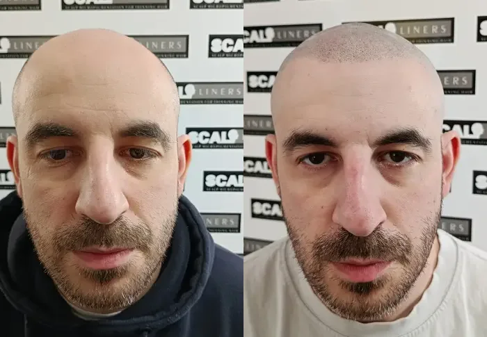 Can bad SMP be fixed? - ScalpLiners Kent Scalp micropigmentation result at ScalpLiners in Kent