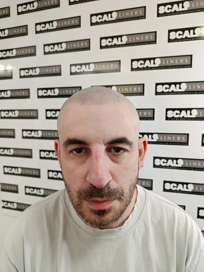 Natural hair density scalp micropigmentation result in Kent