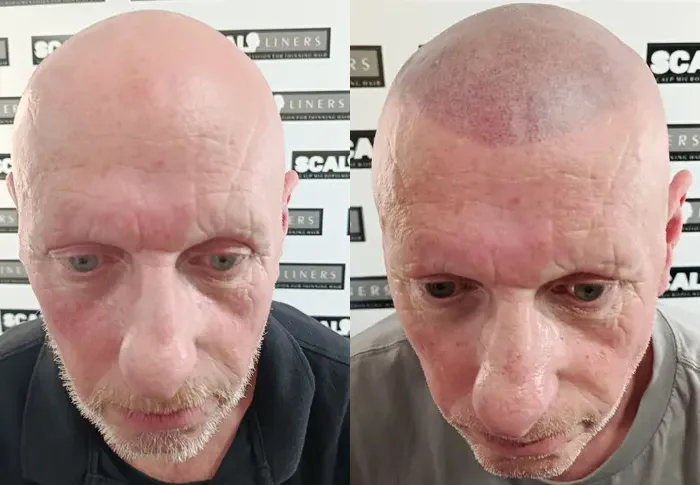 How to choose an SMP artist - ScalpLiners Kent Healed scalp micropigmentation result at ScalpLiners in Kent