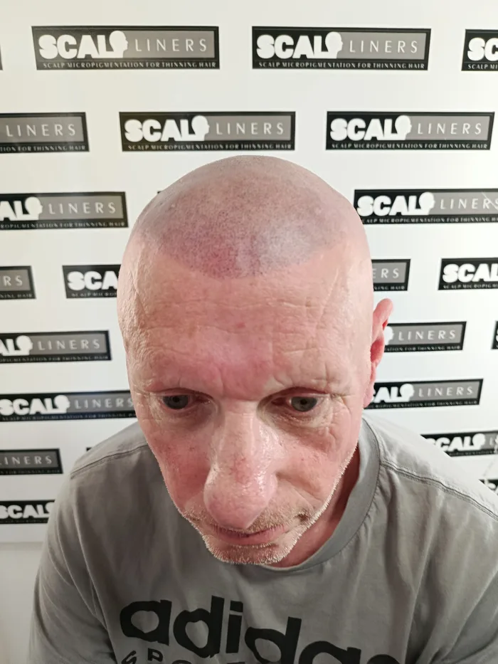 Finished full head scalp micropigmentation result in Kent