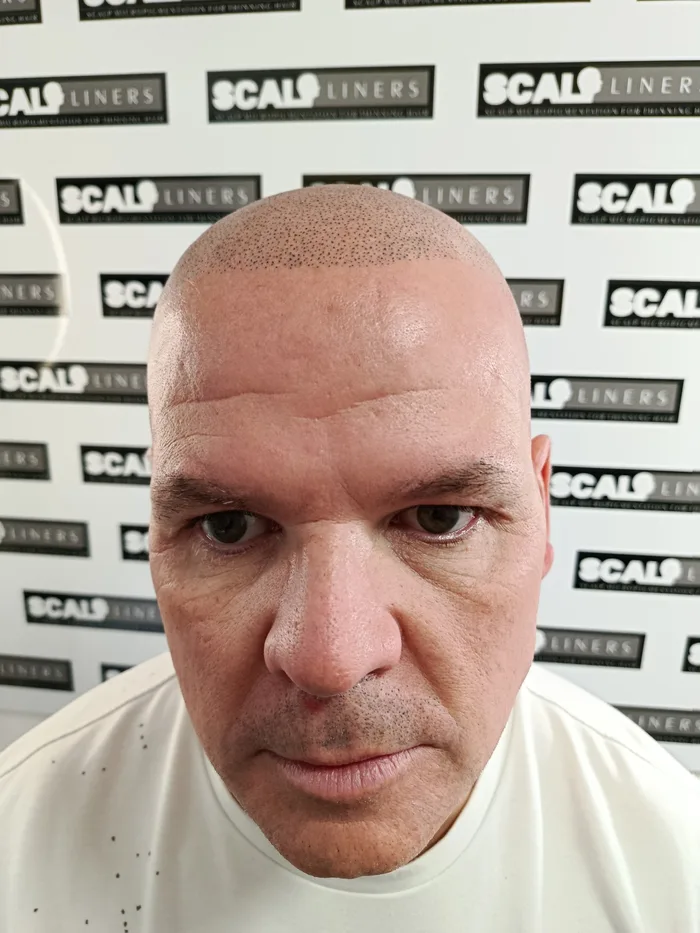 Finished SMP hairline restoration result in Kent
