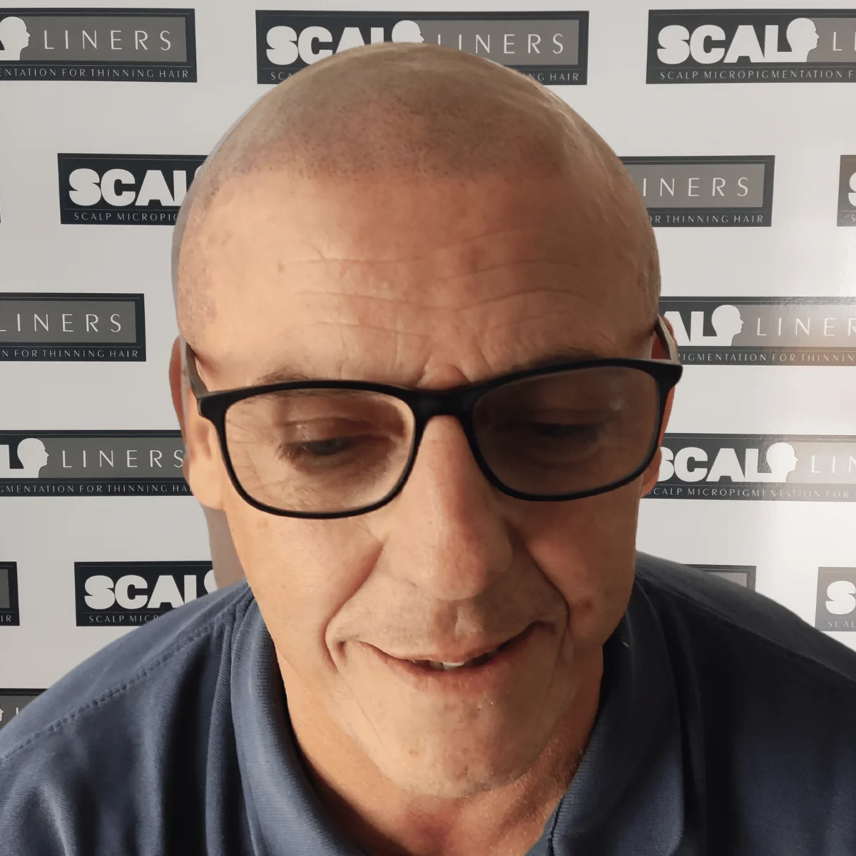 Natural SMP hairline restoration result in Kent by ScalpLiners