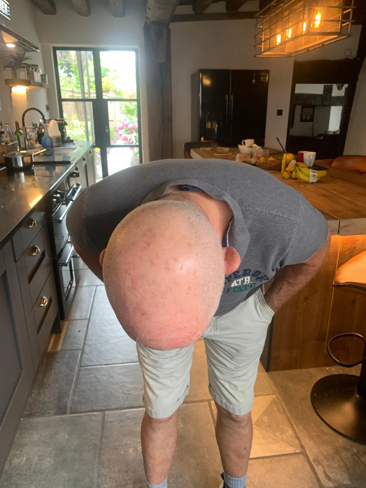 Craig full head SMP before — ScalpLiners Kent