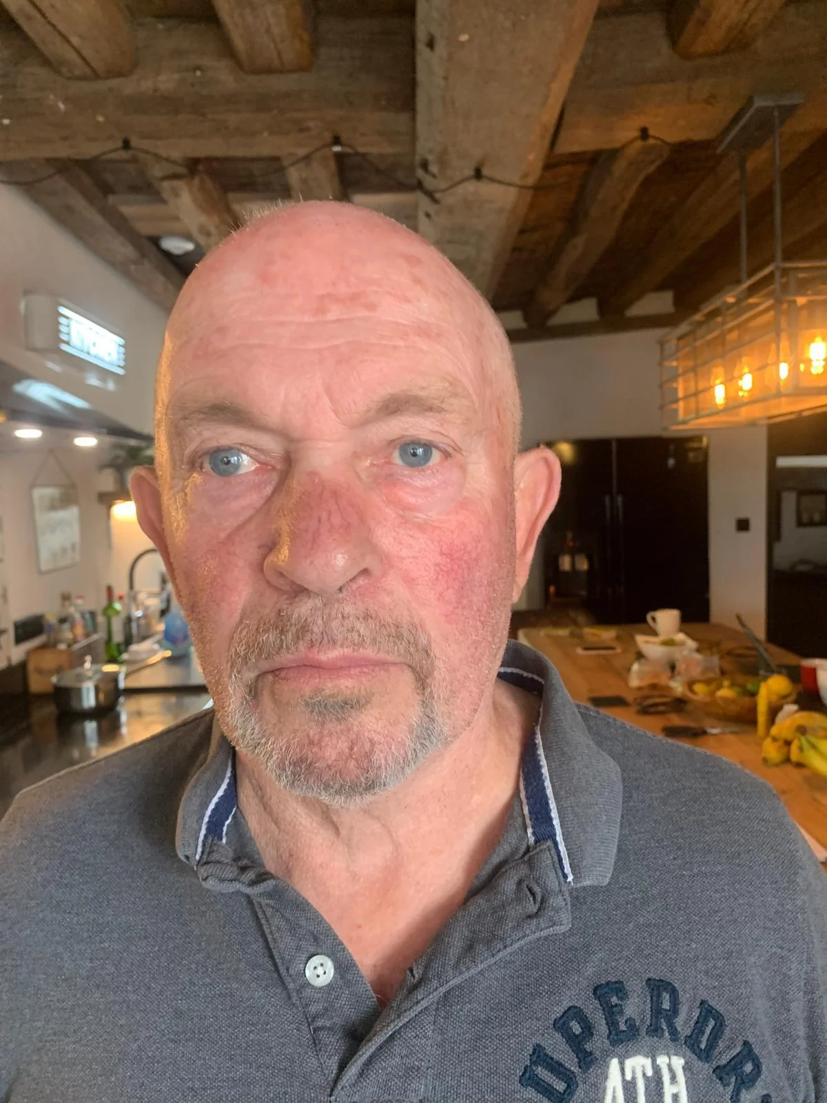 Craig full head SMP during treatment — ScalpLiners Kent