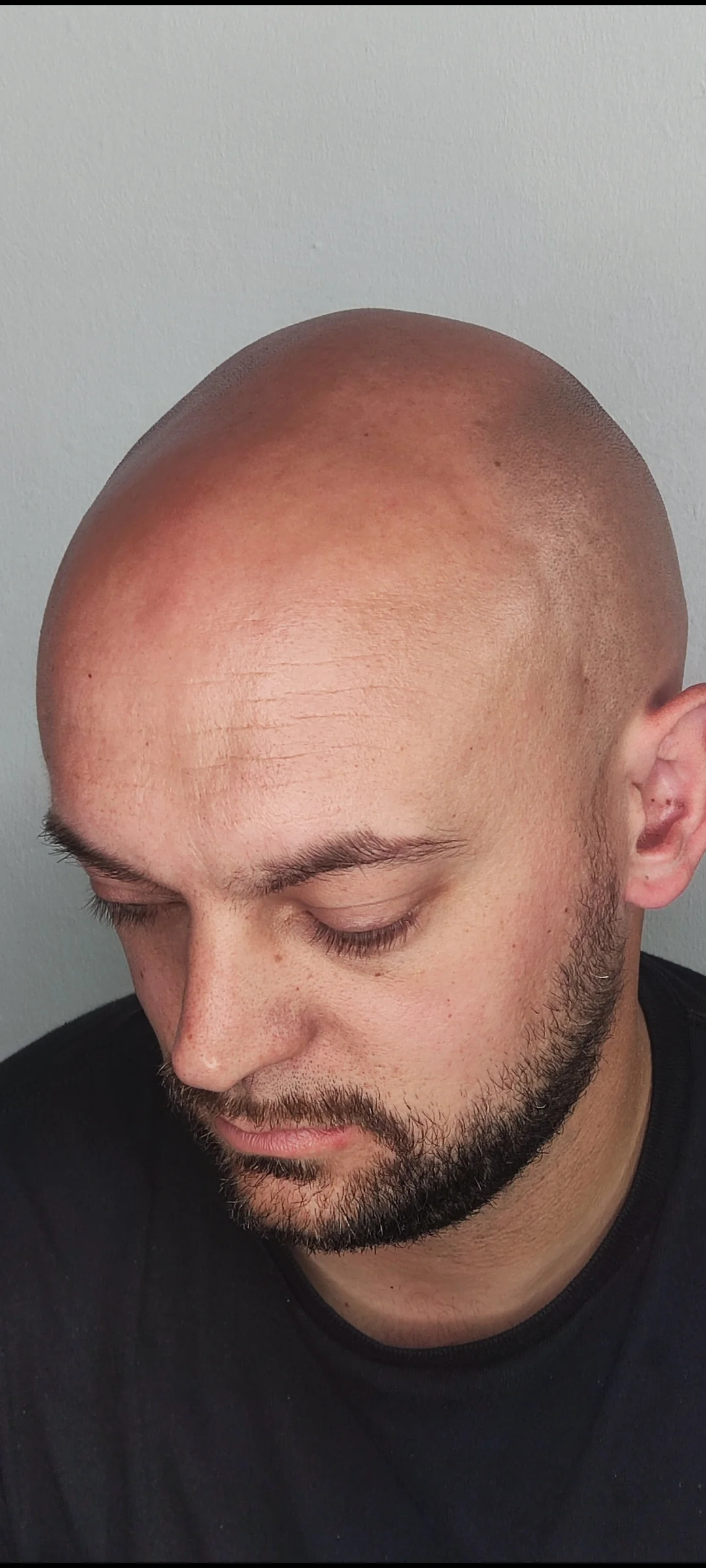 Hair transplant scar before SMP camouflage — ScalpLiners Kent