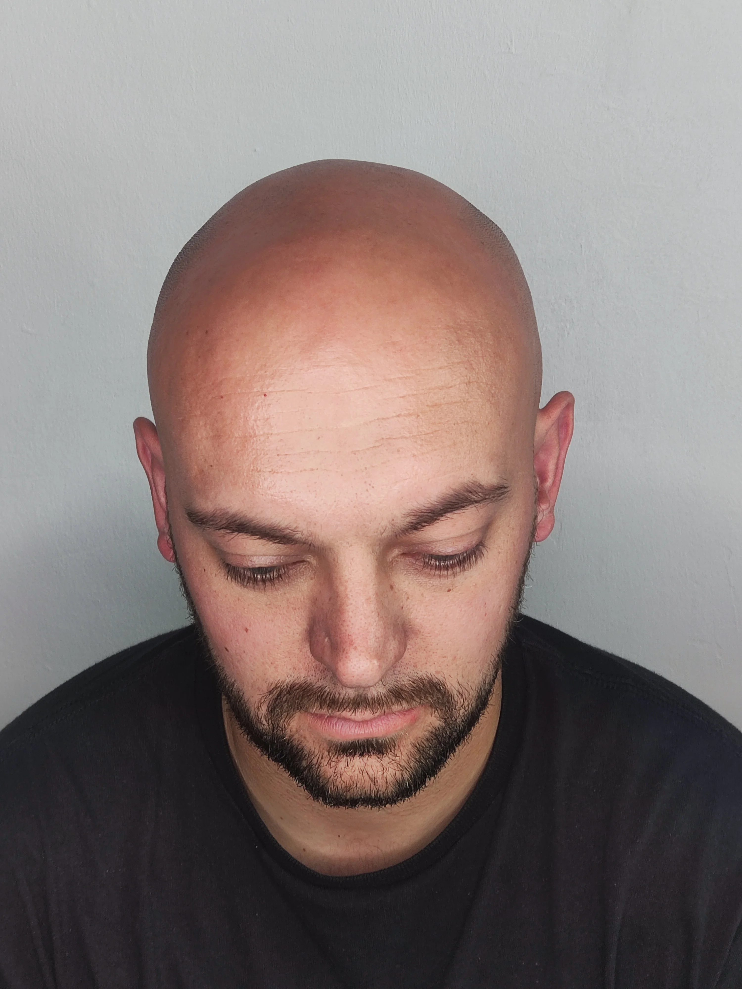 Gary FUE scar camouflage progress — ScalpLiners Kent