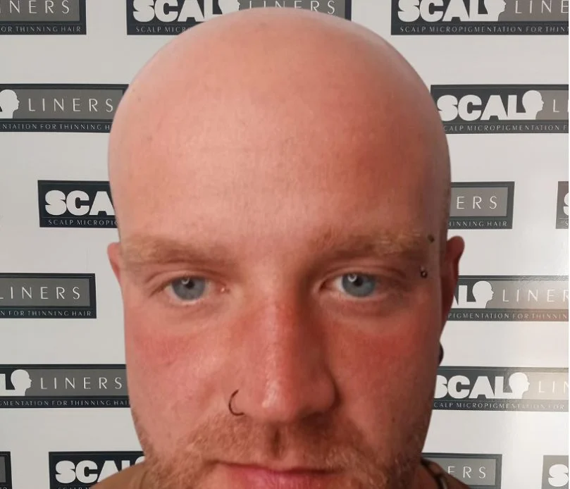 Henry before scalp micropigmentation treatment Sussex