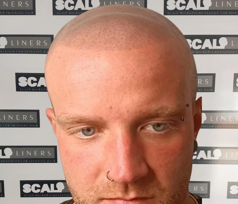 Scalp micropigmentation result for Henry based in Sussex