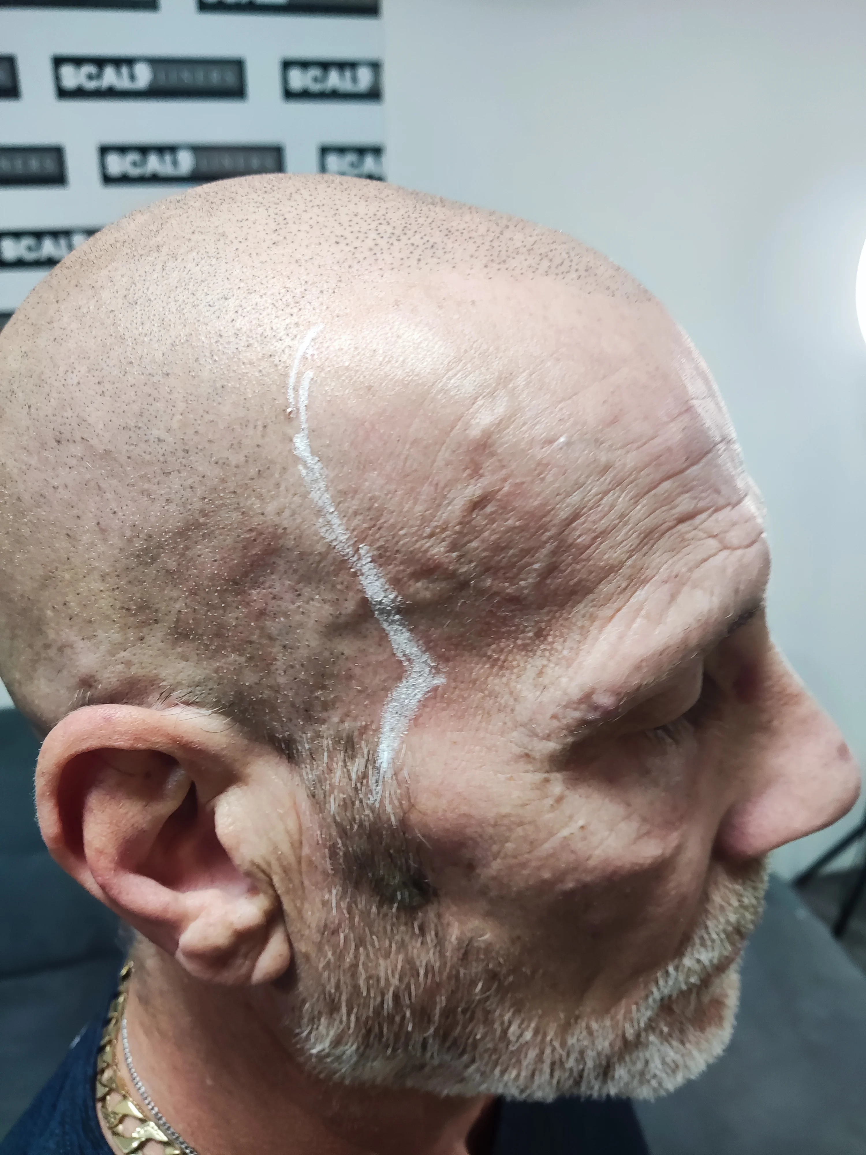 Ian full head SMP session 2 — ScalpLiners Kent