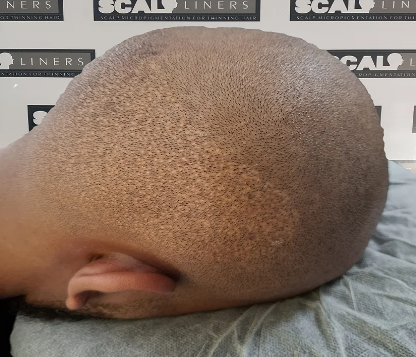 Jim before scalp micropigmentation treatment Ramsgate Kent