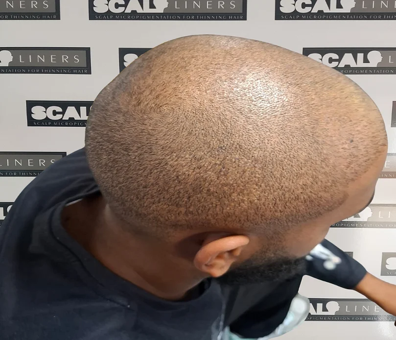 Scalp micropigmentation result for Jim based in Ramsgate Kent